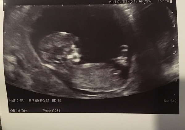 Gender guesses from 12 week scan