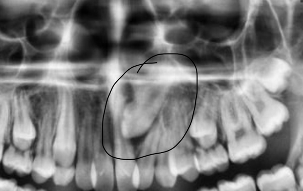 Impacted canine