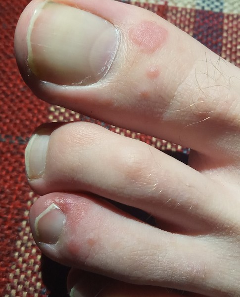 What's wrong with DS's feet?