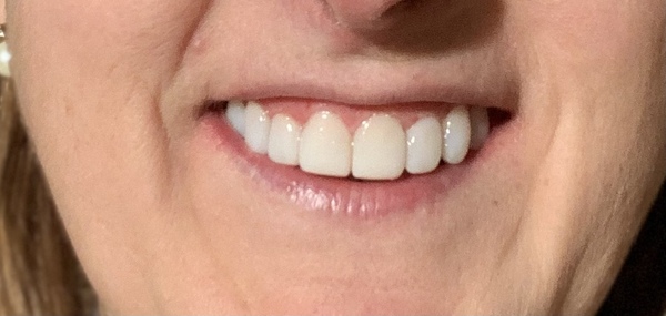Have you had porcelain veneers done?