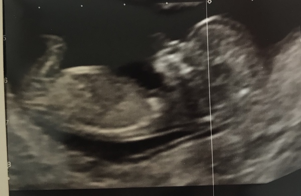 Do you want me to guess the sex? 12 week scans.
