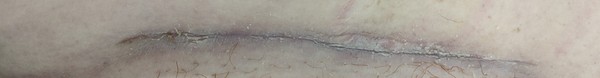 C-section heading properly? Warning *wound photo*