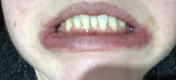 Gum disease (just been diagnosed)