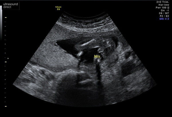 Sonographers/mum of girls - is this really a girl?