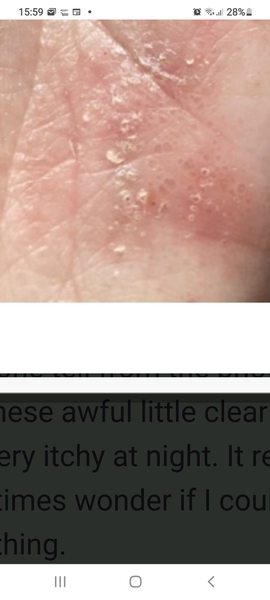 Sorry graphic photo...what type of eczema is this?