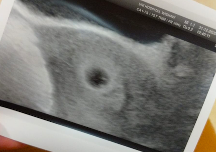 Pregnant after miscarriage - due summer