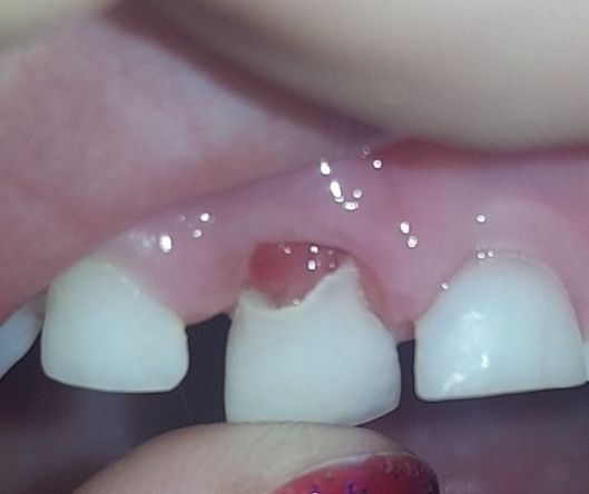 DS tooth?!