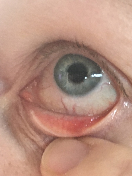 Is this a chalazion (pic)?
