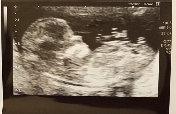 Do you want me to guess the sex? 12 week scans.