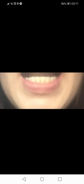 To ask if you have used invisalign? (Or similar aligners?)
