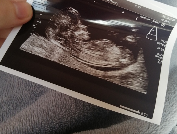 Do you want me to guess the sex? 12 week scans.