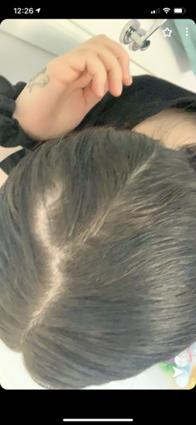 Hair loss postpartum and thinning hair