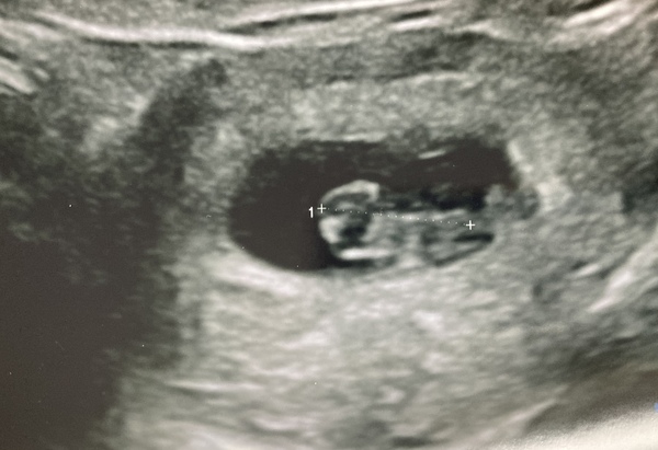 What could you see at 8 week scan?