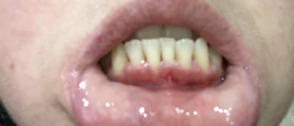 Gum disease (just been diagnosed)