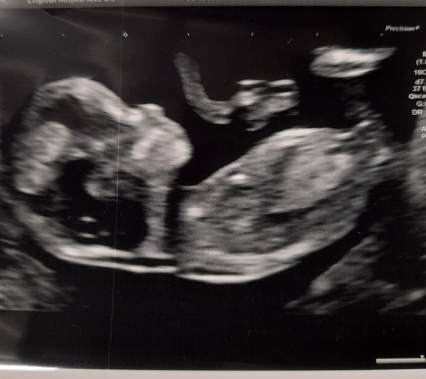 Do you want me to guess the sex? 12 week scans.