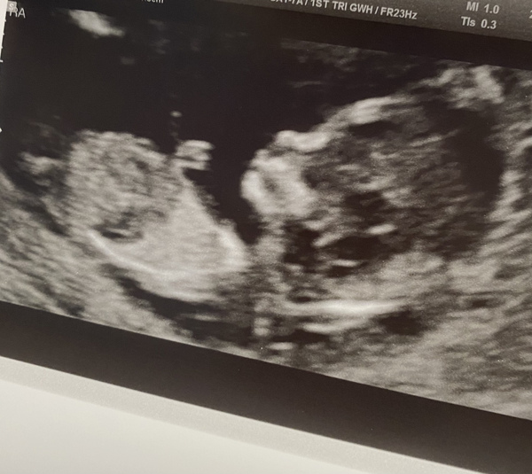 Do you want me to guess the sex? 12 week scans.