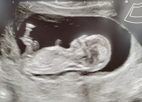 Do you want me to guess the sex? 12 week scans.