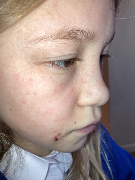 Red spots on DDs face. Eczema?