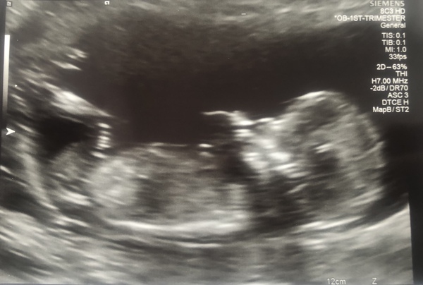 Do you want me to guess the sex? 12 week scans.