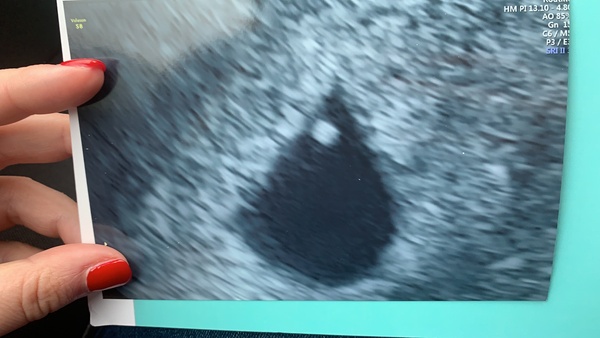 6 week ultrasound