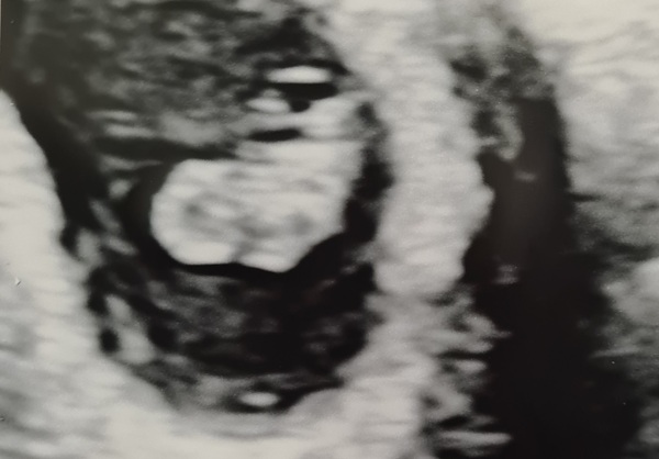 1st scan worries
