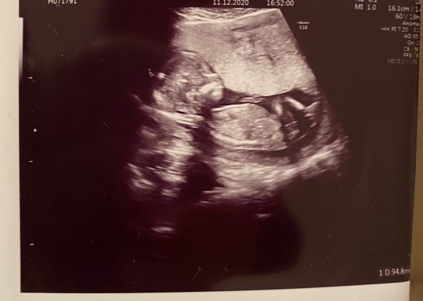 Pregnant After MMC - Thread 4