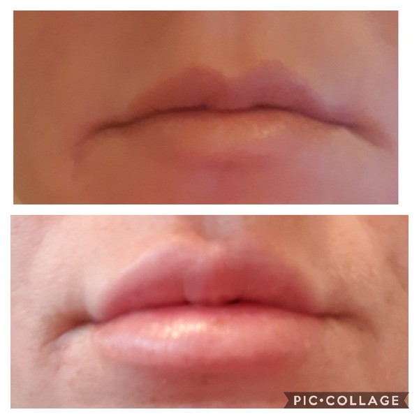 Could fillers fix my wonky lips? (Pic)