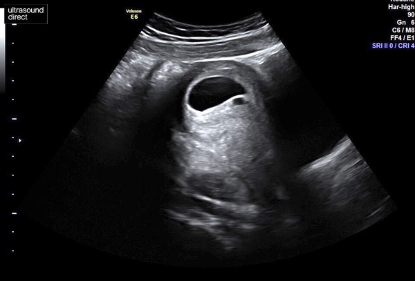 Blighted Ovum scan help