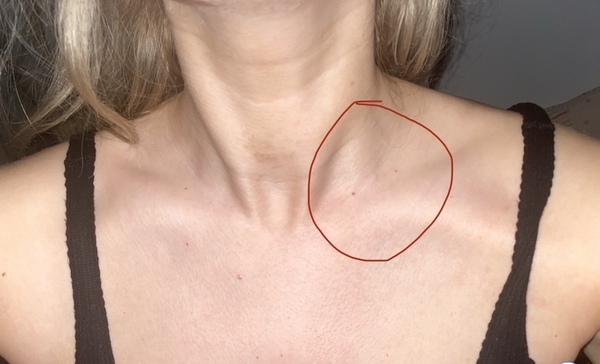Lump On Neck Near Collar Bone Lump On Neck Near Collar Bone