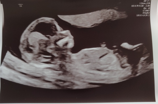 Do you want me to guess the sex? 12 week scans.