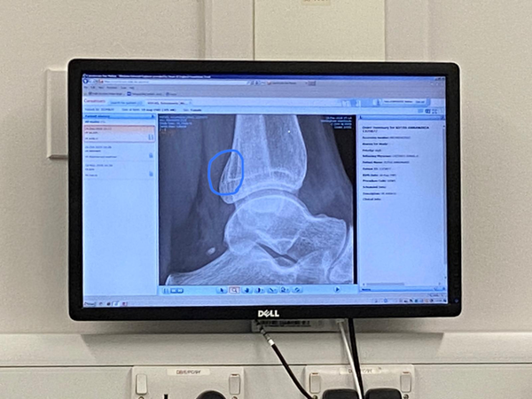 Broken ankle advice with pic