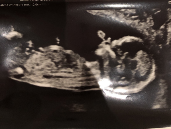 Baby scan boy or girl?