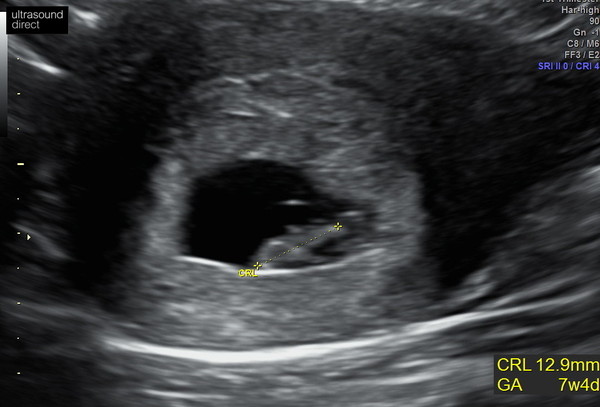 7 week scan with NHS, too early?