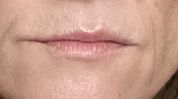 Could fillers fix my wonky lips? (Pic)
