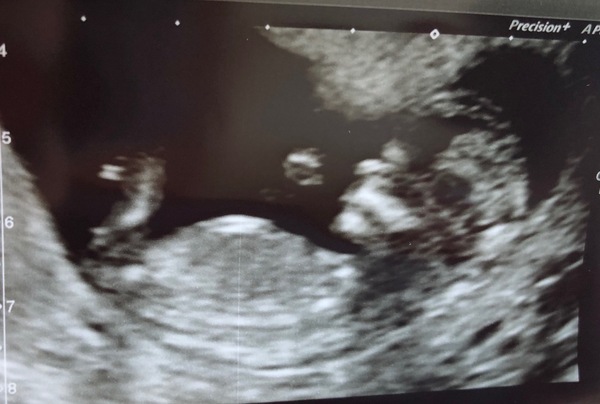Do you want me to guess the sex? 12 week scans.