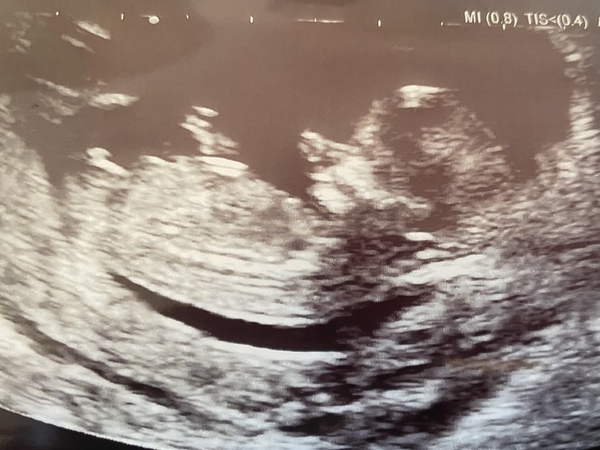 Gender Guesses 12 Week Scan