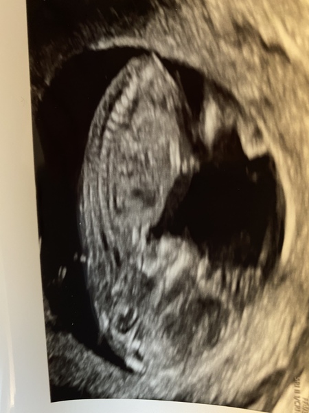 Do you want me to guess the sex? 12 week scans.