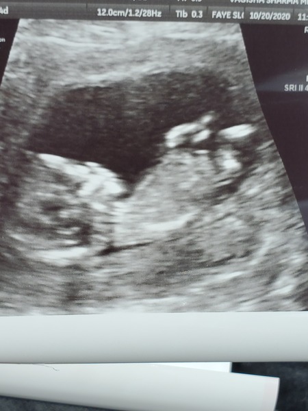 Do you want me to guess the sex? 12 week scans.