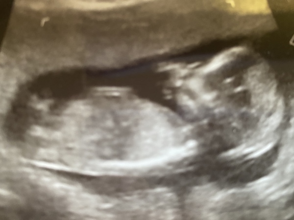 Do you want me to guess the sex? 12 week scans.