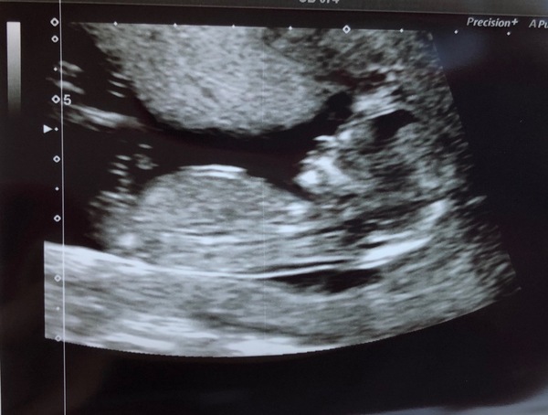 Do you want me to guess the sex? 12 week scans.