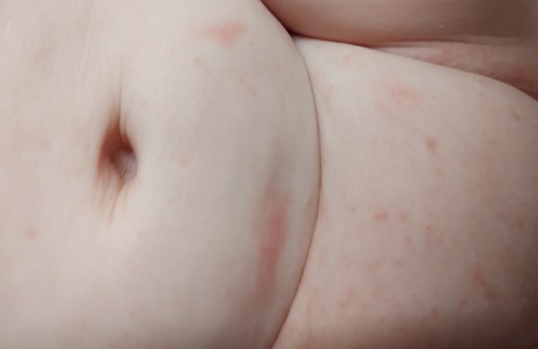 Red spots/marks nappy area