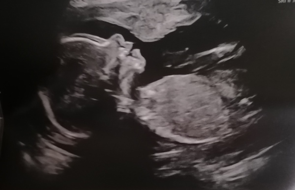 Pregnant After MMC - Thread 4