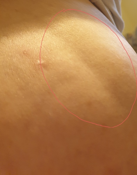 Breast cancer worry.
