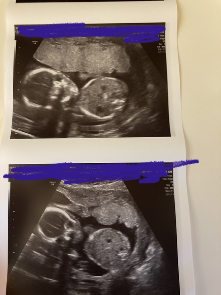 Can anyone confirm baby is a girl from 20week scan!