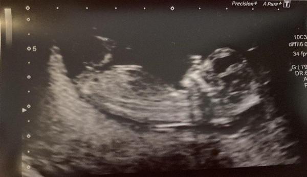 Do you want me to guess the sex? 12 week scans.