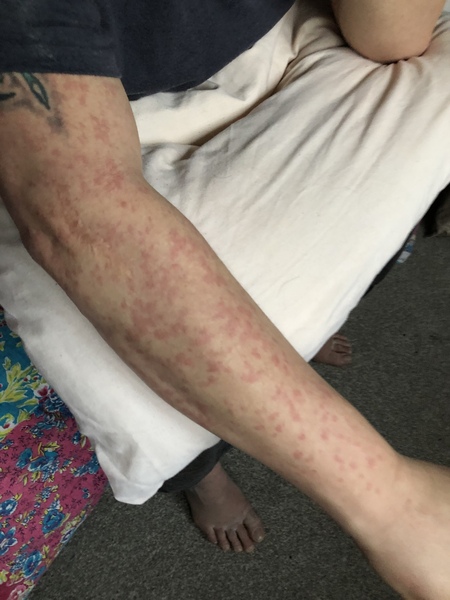 To ask what your childs covid rash looked like