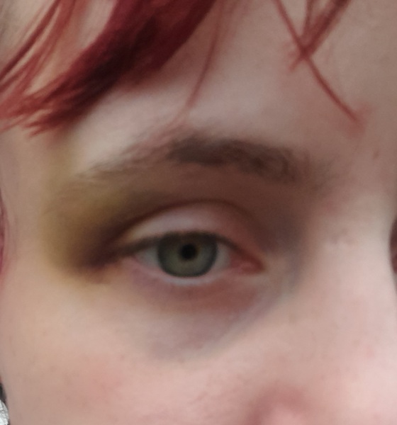 To wonder why my MIL thinks DH gave me a black eye