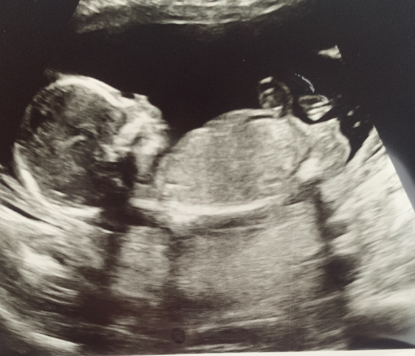 17 week nub..