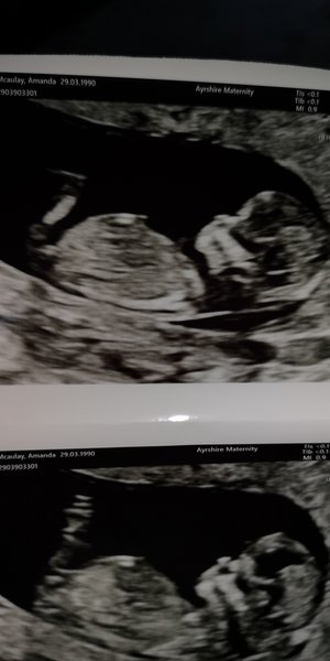 Do you want me to guess the sex? 12 week scans.