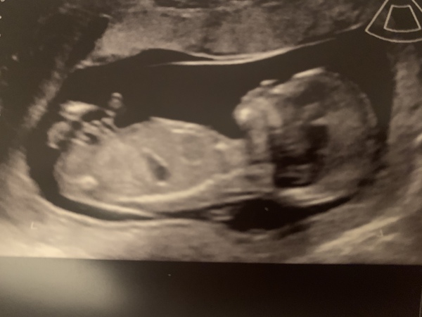 Any skull / nub theory experts around to hazard a guess on this 12 week scan picture?